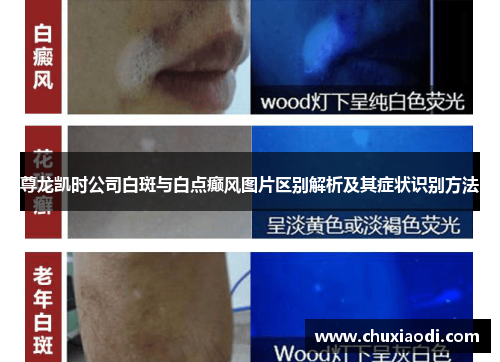 尊龙凯时公司白斑与白点癫风图片区别解析及其症状识别方法